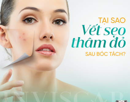 Tại sao sau bóc tách sẹo rỗ lại để lại vết thâm đỏ? Liệu có đáng lo ngại?