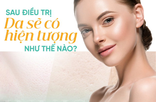 Sau điều trị sẹo rỗ, da sẽ thay đổi như thế nào? Điều cần biết để không hoang mang!