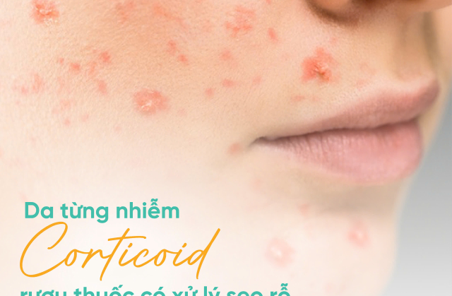 Da từng nhiễm corticoid, rượu thuốc có xử lý sẹo rỗ ngay được không?