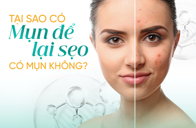 Cùng là mụn, sao bạn để lại sẹo còn người ta thì không?