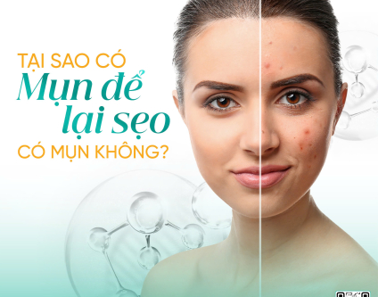 Cùng là mụn, sao bạn để lại sẹo còn người ta thì không?