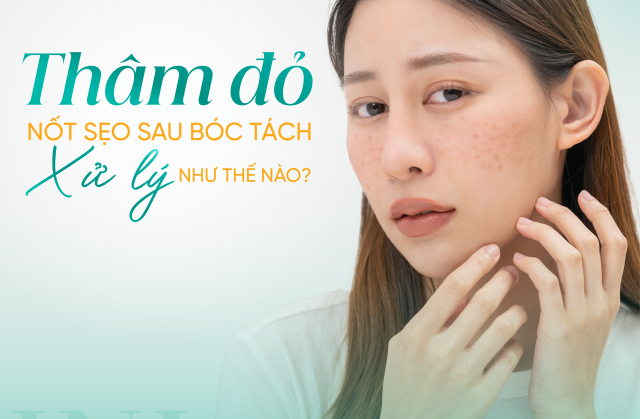 Thâm đỏ tại nốt sẹo sau bóc tách xử lý như thế nào?