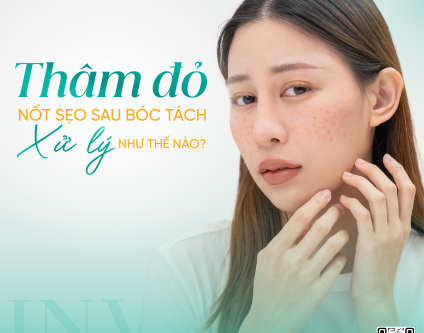 Thâm đỏ tại nốt sẹo sau bóc tách xử lý như thế nào?