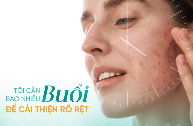 Cần bao nhiêu buổi để cải thiện sẹo rõ rệt?